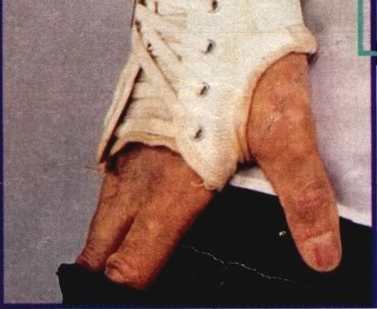 vitiligo4
